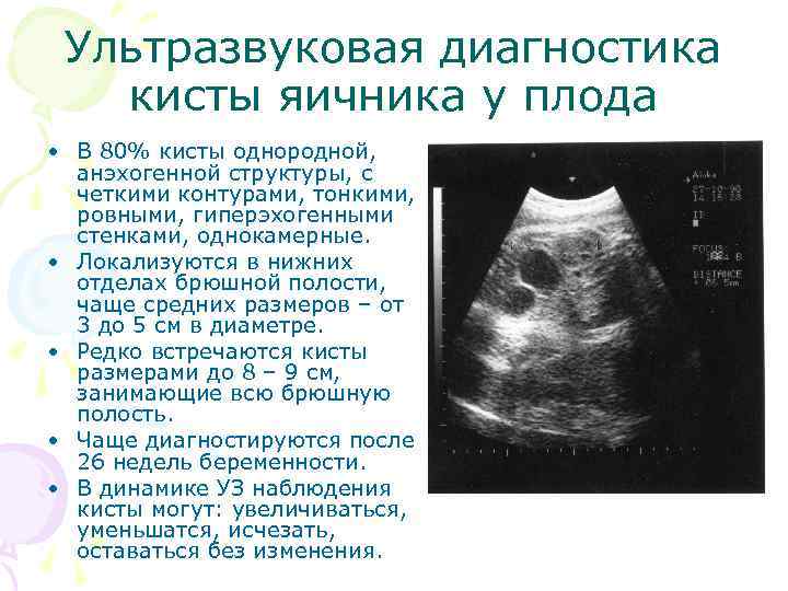 Ультразвуковая диагностика кисты яичника у плода • В 80% кисты однородной, анэхогенной структуры, с