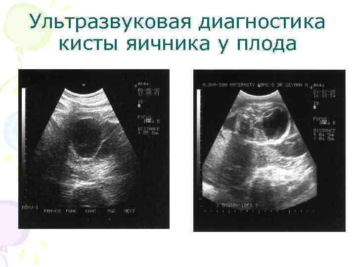 Ультразвуковая диагностика кисты яичника у плода 