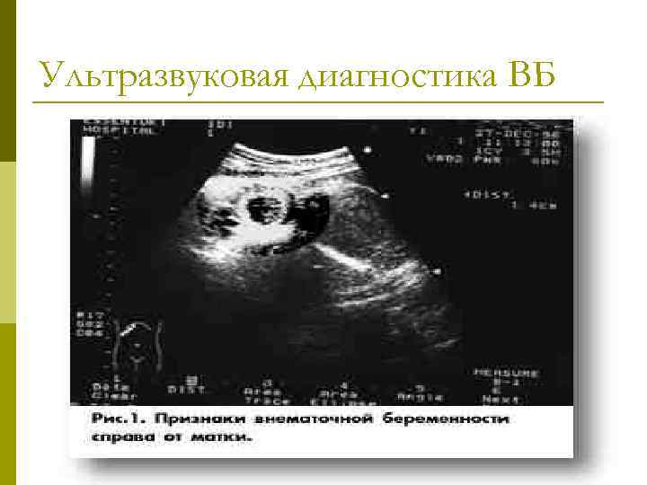 Ультразвуковая диагностика ВБ 