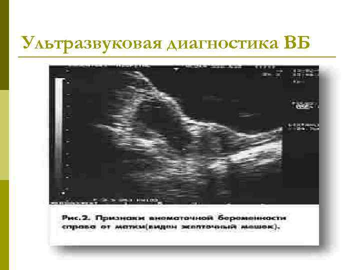 Ультразвуковая диагностика ВБ 