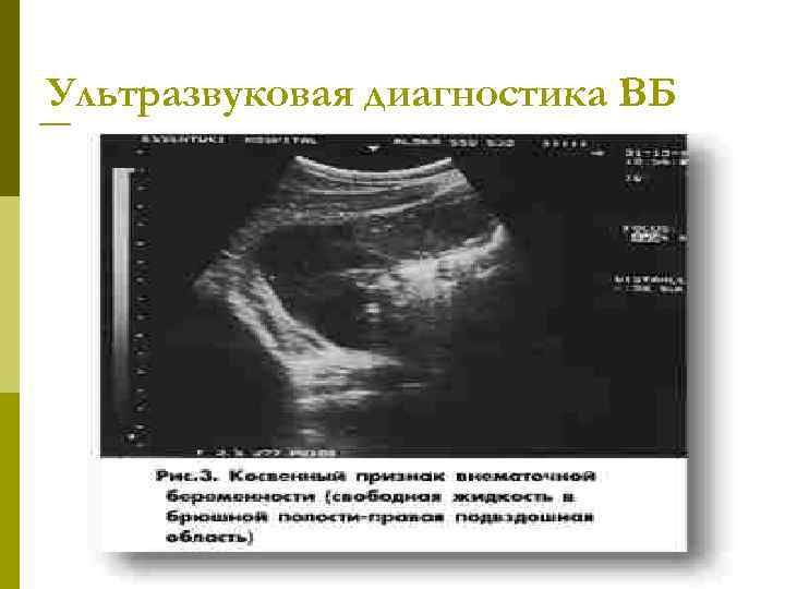 Ультразвуковая диагностика ВБ 