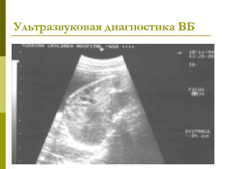 Ультразвуковая диагностика ВБ 
