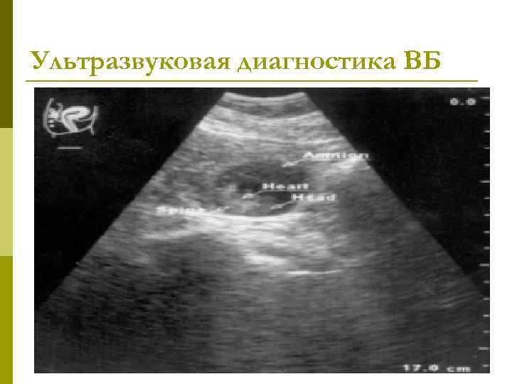 Ультразвуковая диагностика ВБ 