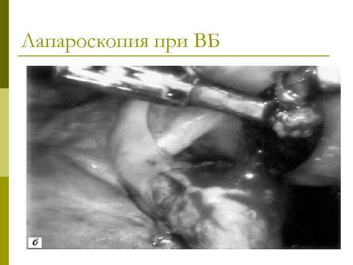 Лапароскопия при ВБ 