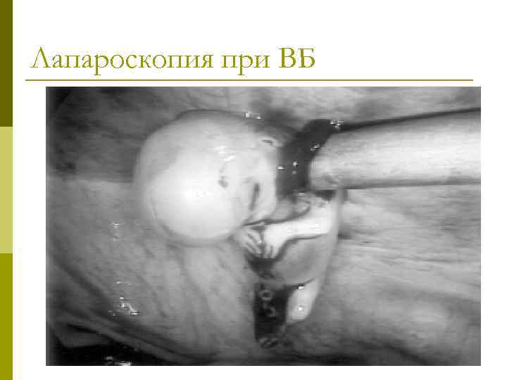 Лапароскопия при ВБ 