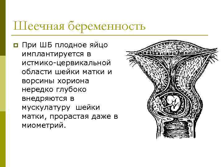 Шеечная беременность p При ШБ плодное яйцо имплантируется в истмико-цервикальной области шейки матки и