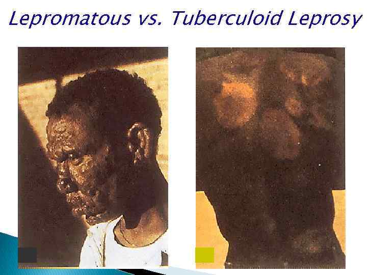Lepromatous vs. Tuberculoid Leprosy 
