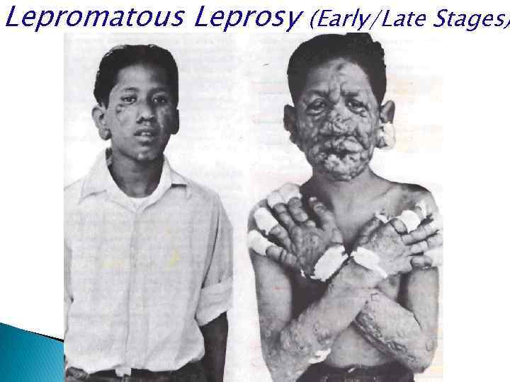 Lepromatous Leprosy (Early/Late Stages) 