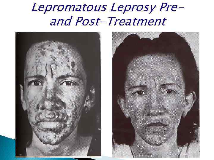 Lepromatous Leprosy Preand Post-Treatment 