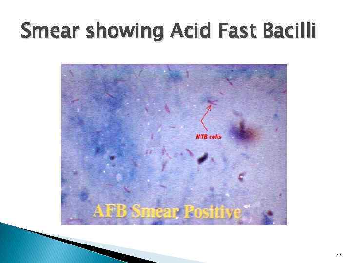 Smear showing Acid Fast Bacilli 16 