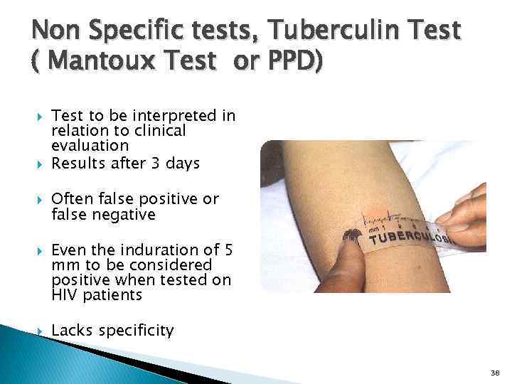 Non Specific tests, Tuberculin Test ( Mantoux Test or PPD) Test to be interpreted