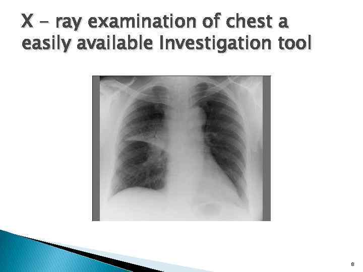 X - ray examination of chest a easily available Investigation tool 8 