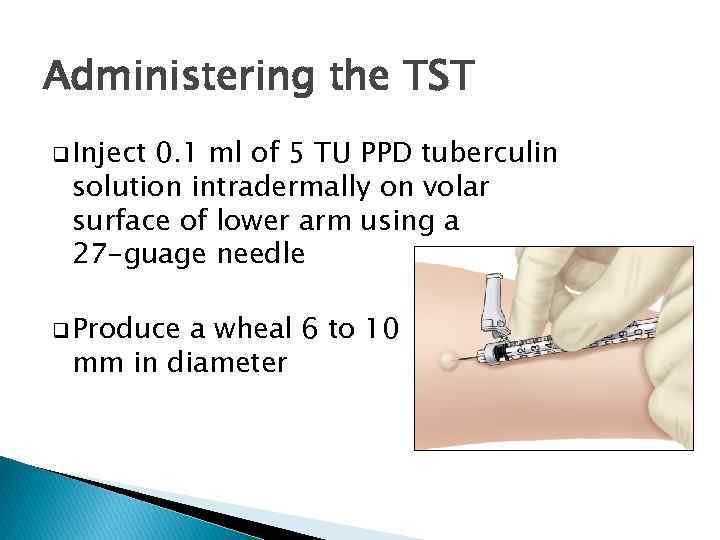 Administering the TST q Inject 0. 1 ml of 5 TU PPD tuberculin solution