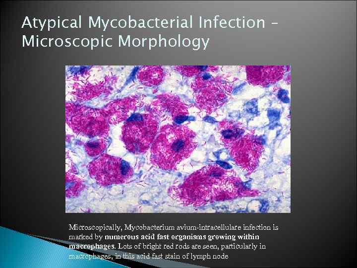 Atypical Mycobacterial Infection – Microscopic Morphology Microscopically, Mycobacterium avium-intracellulare infection is marked by numerous