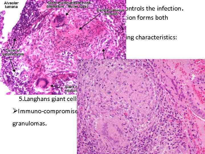 ØIn 95% cases cell mediated immunity controls the infection. Histologically: Granulomatous inflammation forms both