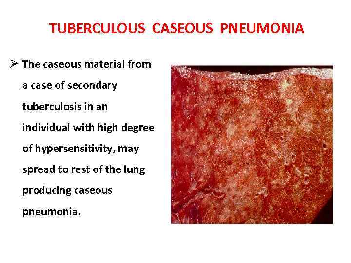 TUBERCULOUS CASEOUS PNEUMONIA Ø The caseous material from a case of secondary tuberculosis in