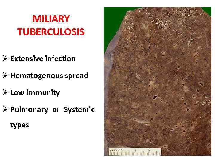 MILIARY TUBERCULOSIS Ø Extensive infection Ø Hematogenous spread Ø Low immunity Ø Pulmonary or