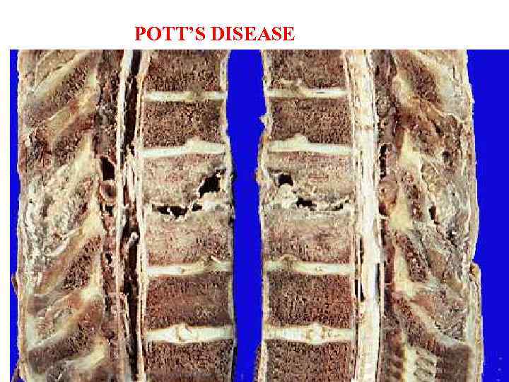 POTT’S DISEASE 