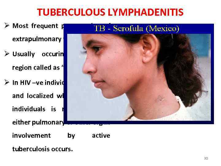 TUBERCULOUS LYMPHADENITIS Ø Most frequent presentation of extrapulmonary tuberculosis. Ø Usually occuring in cervical
