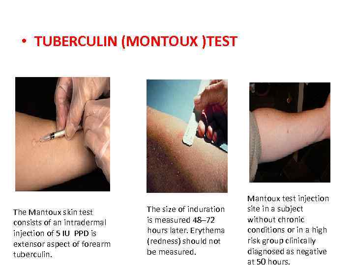  • TUBERCULIN (MONTOUX )TEST The Mantoux skin test consists of an intradermal injection
