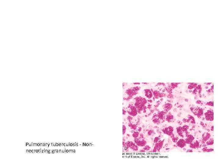 Pulmonary tuberculosis - Nonnecrotizing granuloma 