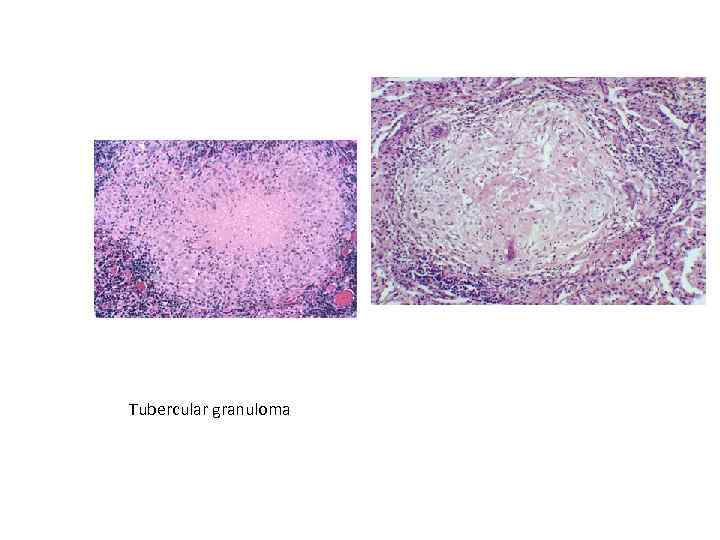 Tubercular granuloma 
