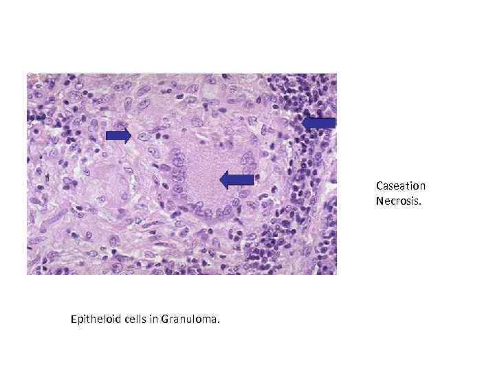 Caseation Necrosis. Epitheloid cells in Granuloma. 