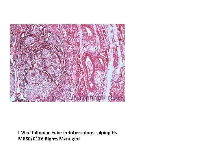 LM of fallopian tube in tuberculous salpingitis M 850/0126 Rights Managed 