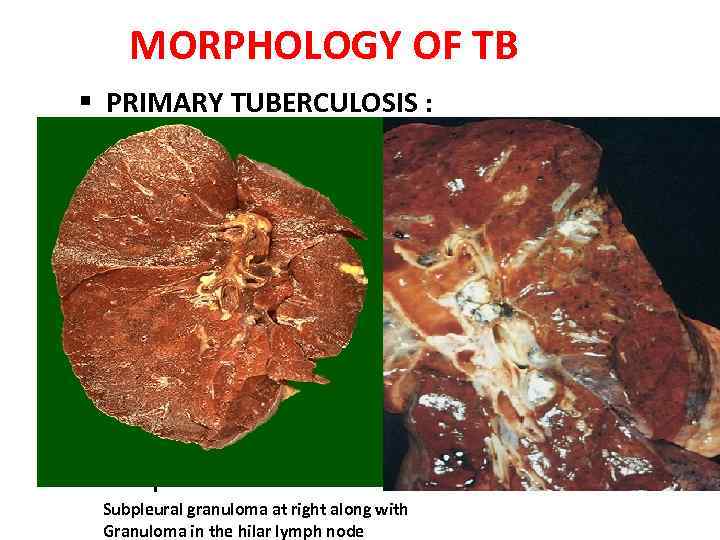 MORPHOLOGY OF TB § PRIMARY TUBERCULOSIS : • Form of disease that develops in