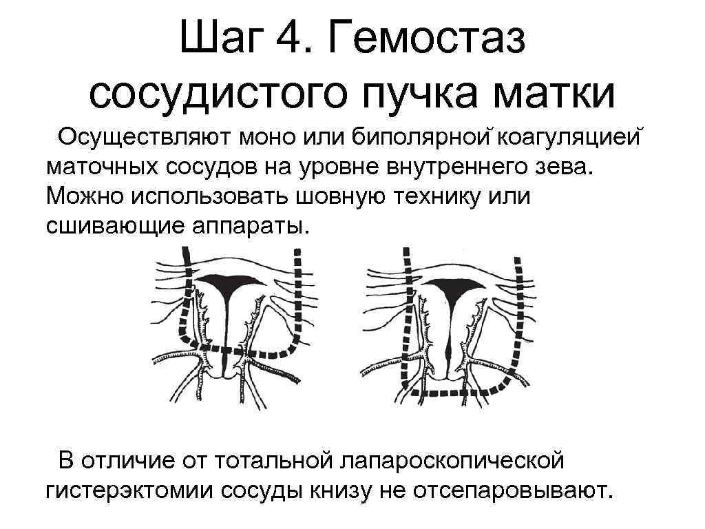 Сосудистый пучок. Сосудистые маточные пучки. Хирургический гемостаз маточных сосудов. Состав сосудистого пучка.