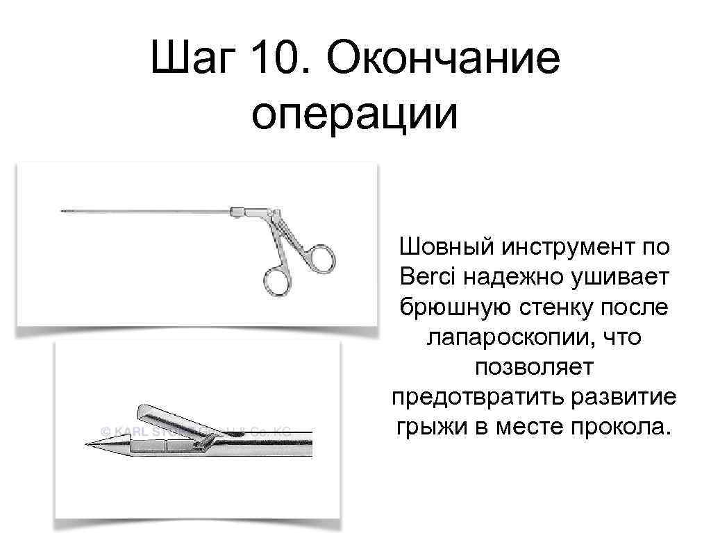 Шаг 10. Окончание операции Шовный инструмент по Berci надежно ушивает брюшную стенку после лапароскопии,