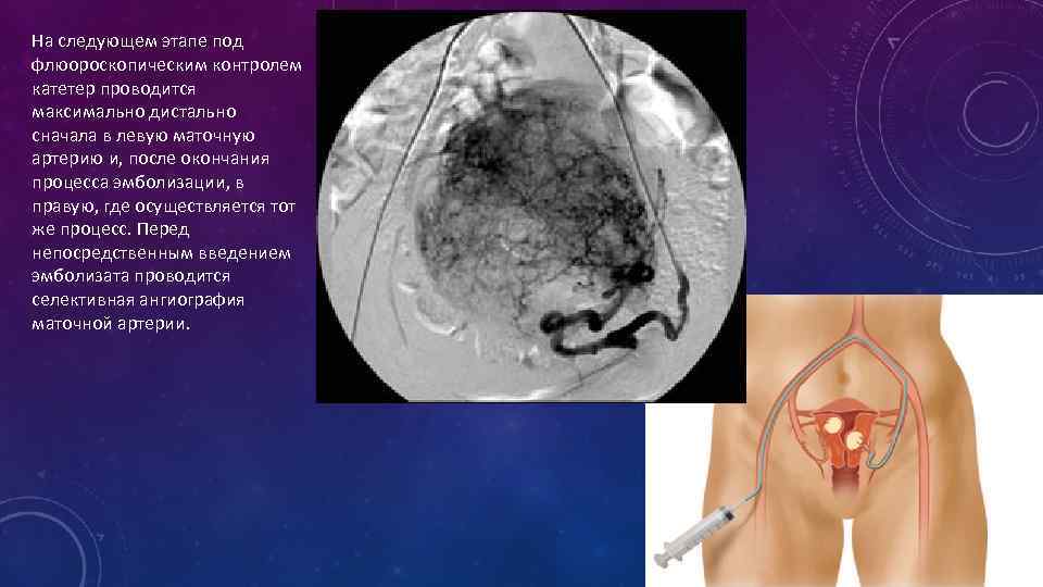 На следующем этапе под флюороскопическим контролем катетер проводится максимально дистально сначала в левую маточную