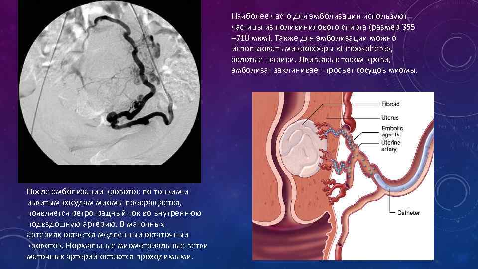 Эмболизация маточных артерий при миоме
