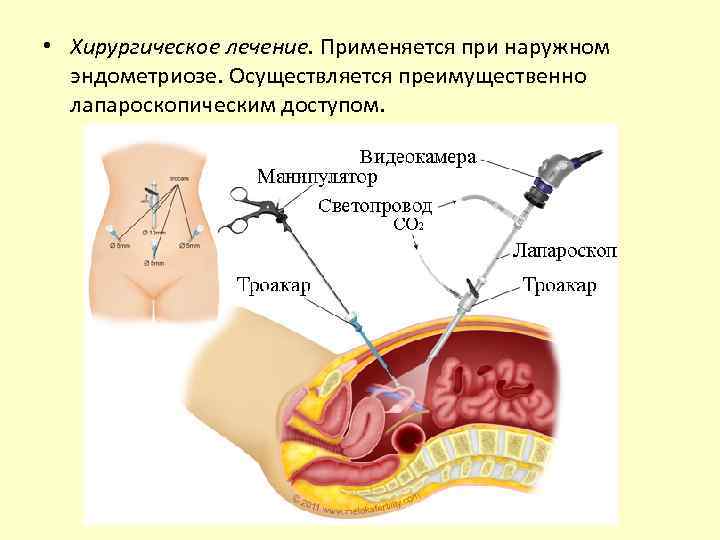  • Хирургическое лечение. Применяется при наружном эндометриозе. Осуществляется преимущественно лапароскопическим доступом. 