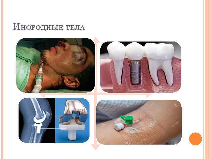 ИНОРОДНЫЕ ТЕЛА 