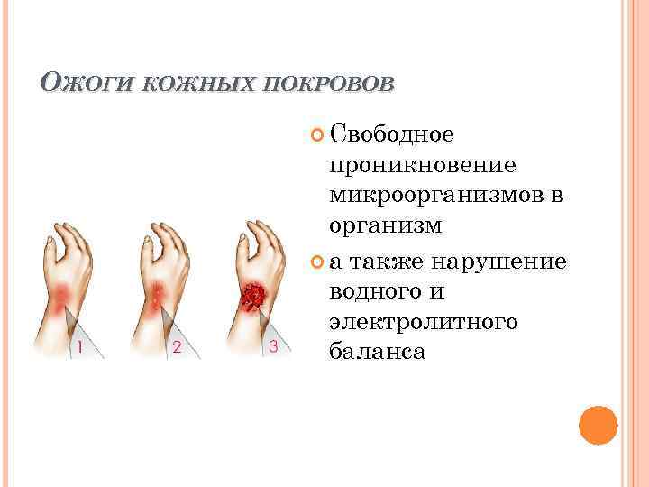 ОЖОГИ КОЖНЫХ ПОКРОВОВ Свободное проникновение микроорганизмов в организм а также нарушение водного и электролитного