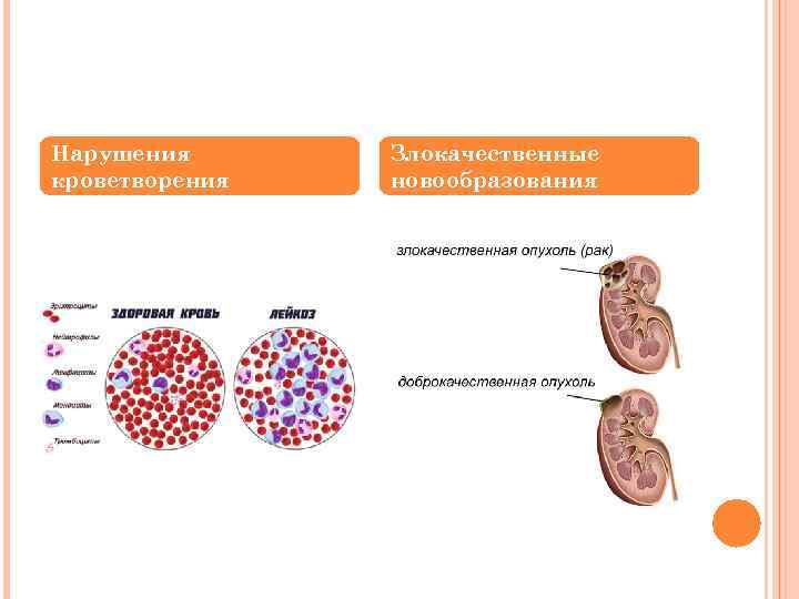 Нарушения кроветворения Злокачественные новообразования 
