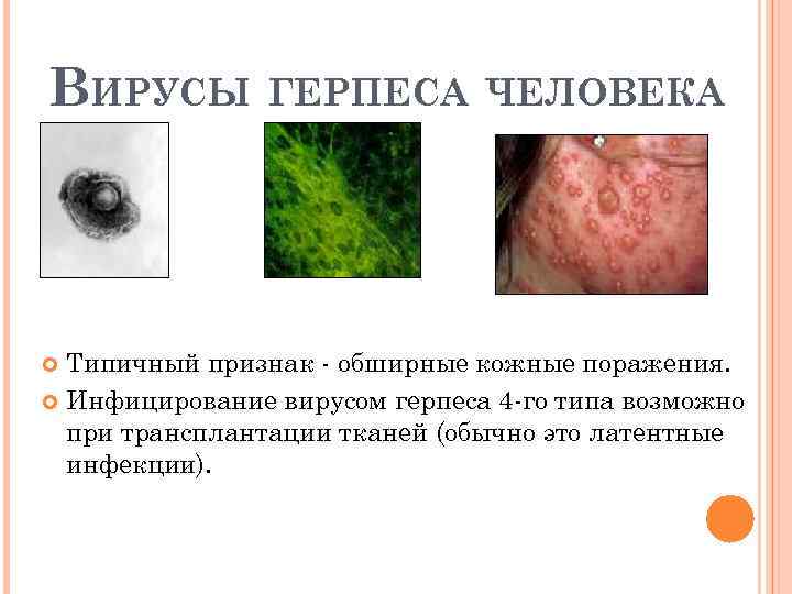 ВИРУСЫ ГЕРПЕСА ЧЕЛОВЕКА Типичный признак обширные кожные поражения. Инфицирование вирусом герпеса 4 го типа