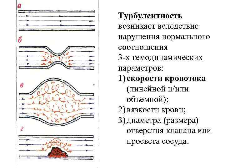 Турбулентность возникает вследствие нарушения нормального соотношения 3 -х гемодинамических параметров: 1) скорости кровотока (линейной