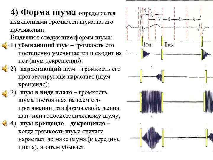 4) Форма шума определяется изменениями громкости шума на его протяжении. Выделяют следующие формы шума: