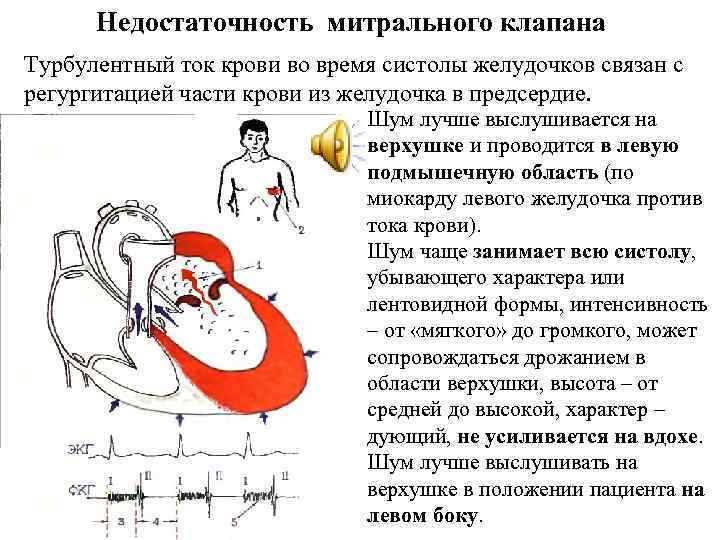 Недостаточность митрального клапана код