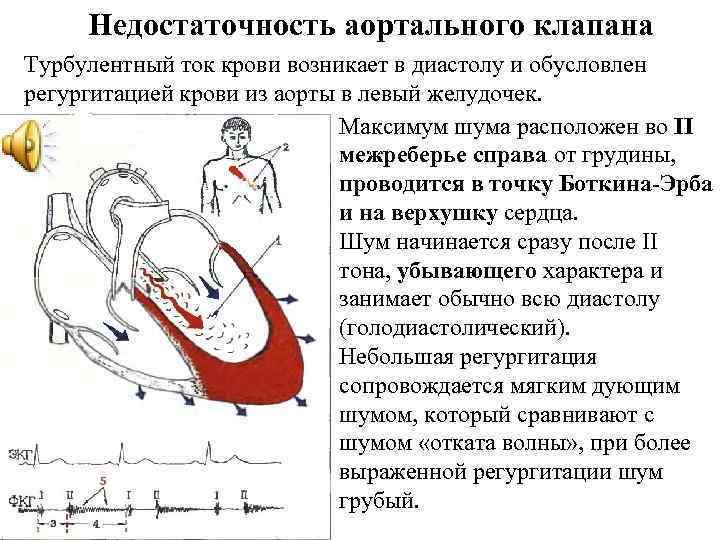 Недостаточность аортального клапана Турбулентный ток крови возникает в диастолу и обусловлен регургитацией крови из