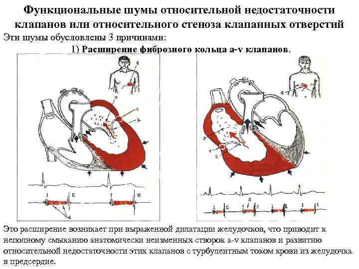 Функциональные шумы относительной недостаточности клапанов или относительного стеноза клапанных отверстий Эти шумы обусловлены 3