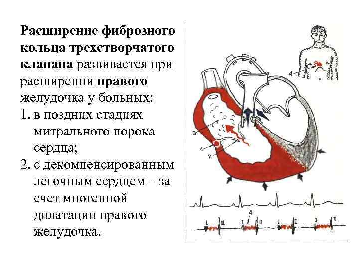 Расширение фиброзного кольца трехстворчатого клапана развивается при расширении правого желудочка у больных: 1. в