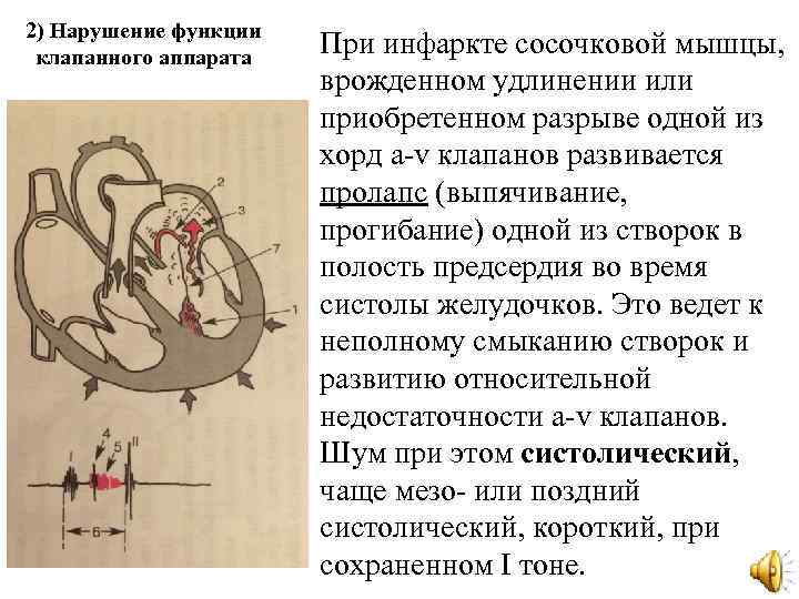 2) Нарушение функции клапанного аппарата При инфаркте сосочковой мышцы, врожденном удлинении или приобретенном разрыве