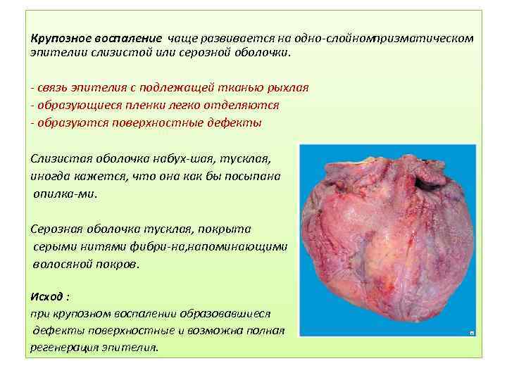 Крупозное воспаление чаще развивается на одно слойном призматическом эпителии слизистой или серозной оболочки. связь