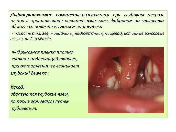 Дифтеритическое воспаление развивается при глубоком некрозе ткани и пропитывании некротических масс фибрином на слизистых