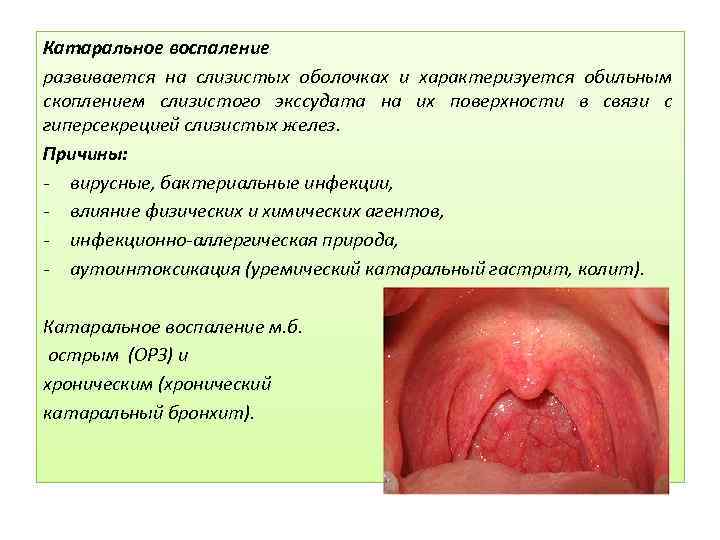 Катаральное воспаление развивается на слизистых оболочках и характеризуется обильным скоплением слизистого экссудата на их