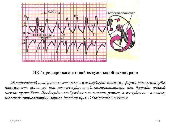 Эктопический это