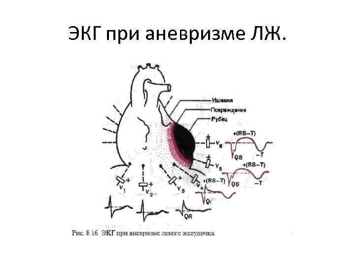 ЭКГ при аневризме ЛЖ. 
